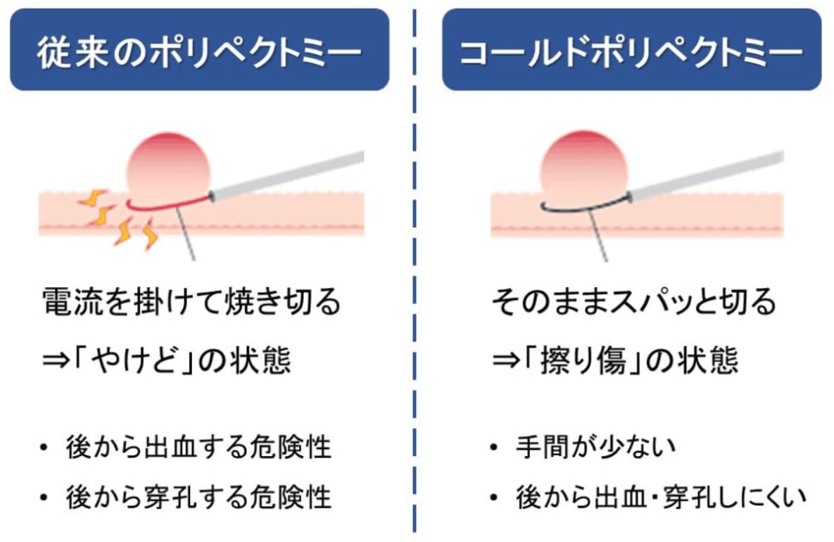 横須賀の石橋クリニックにおける大腸カメラ検査でのポリペクトミーのイラスト